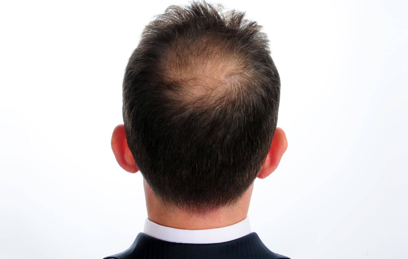 PRP Hair Loss Treatment Kelowna Naturopathic Doctor