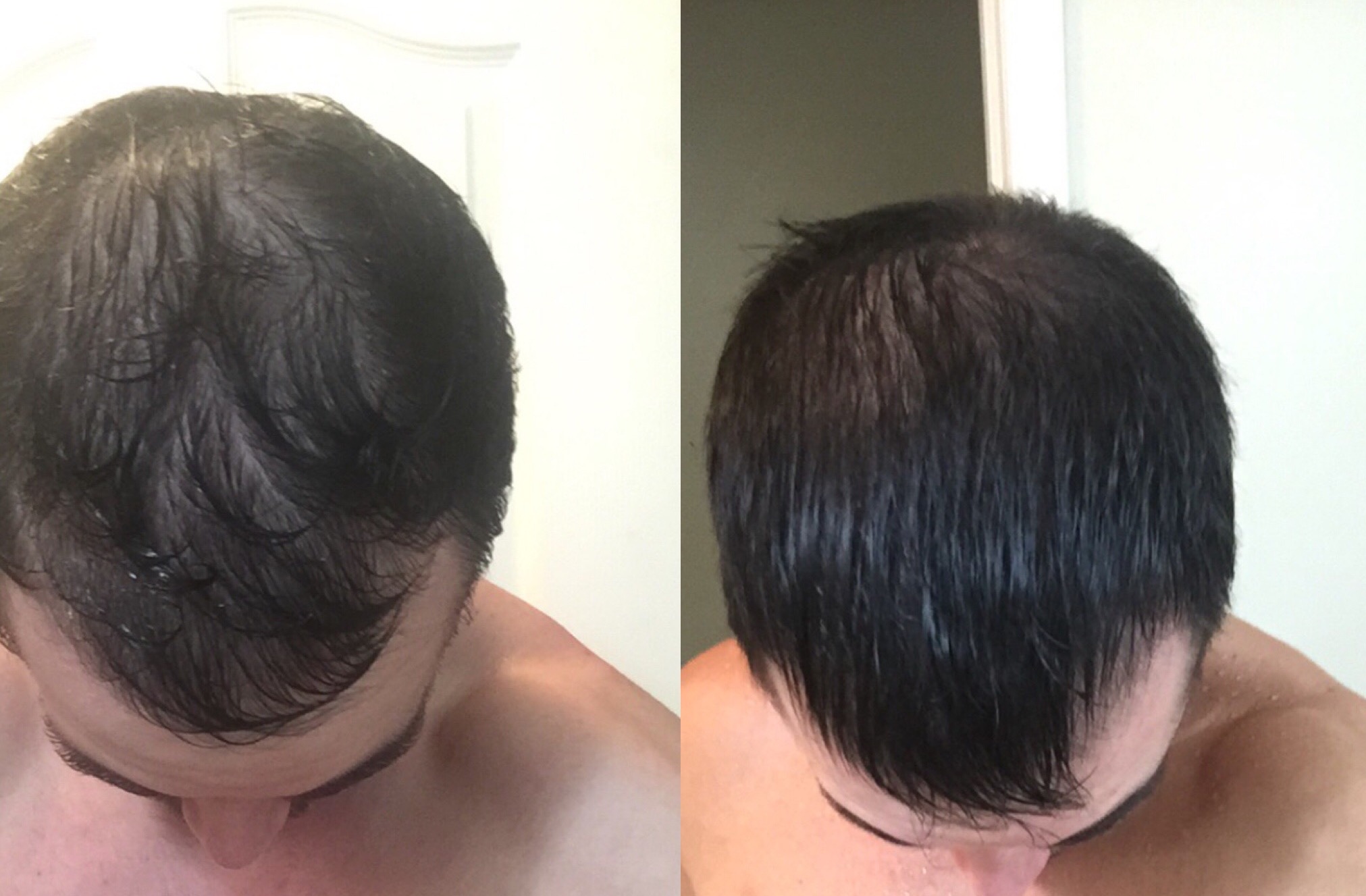 PRP Hair Loss Treatment Kelowna Naturopathic Doctor